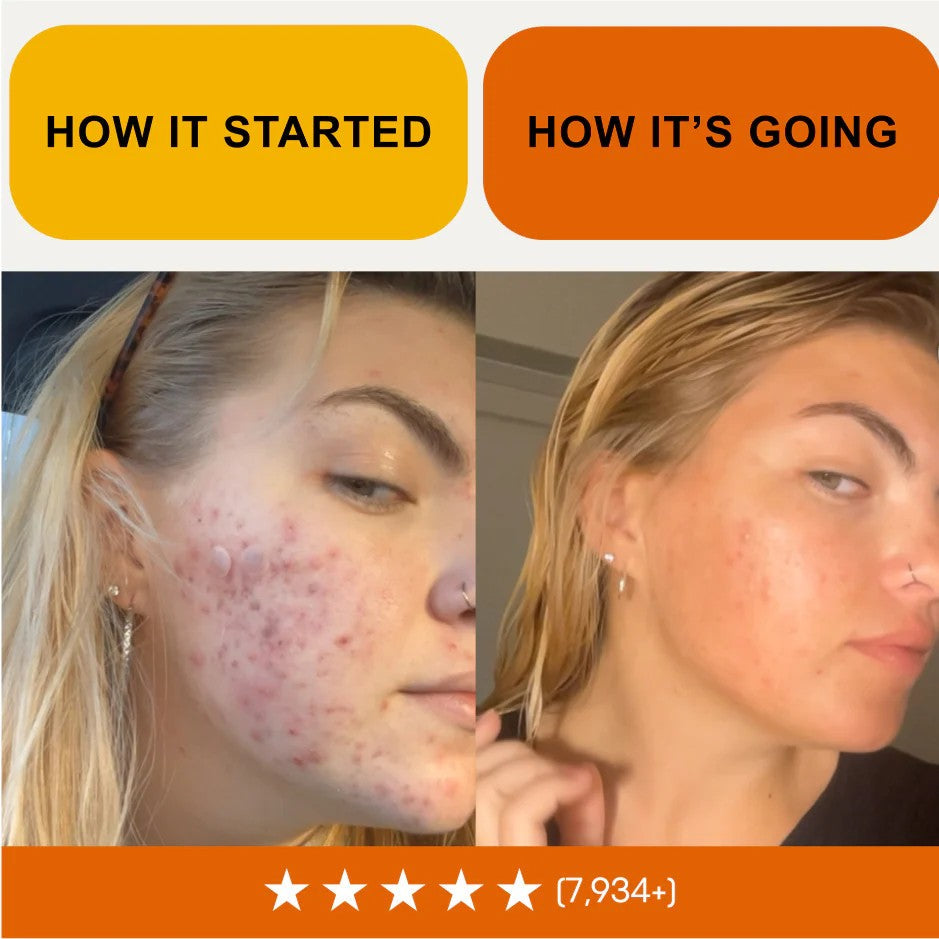 Kill Acne & Redness Ritual-Limited-Time🌲 Christmas Sale: 50% Off🎁