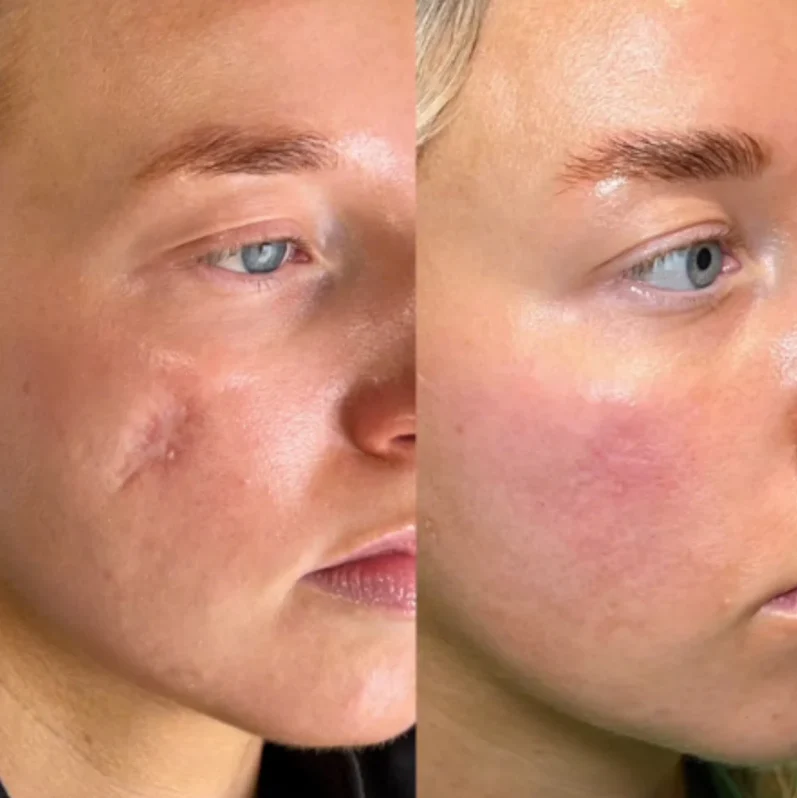 ODALIT™ Silicon ScarStick — Buy 1 Get 1 FREE 🎁LAST DAY⏰| Just $12.49 Each